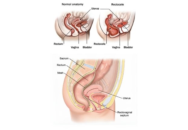 Rectocele